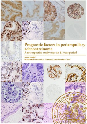 Prognostic factors in periampullary adenocarcinoma